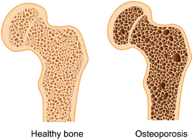 Ostoeporosis 1